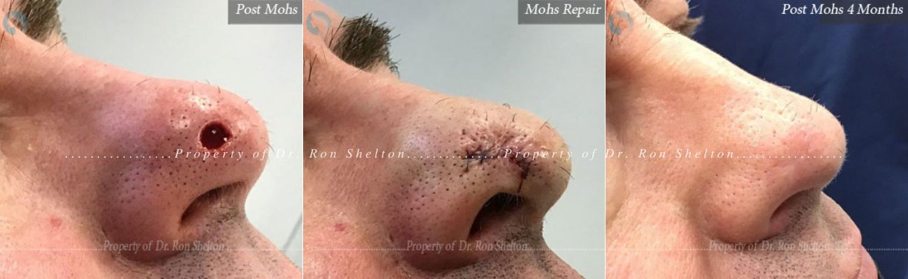 Post Mohs surgery, Mohs Repair and Post Mohs 4 Months on the Nose