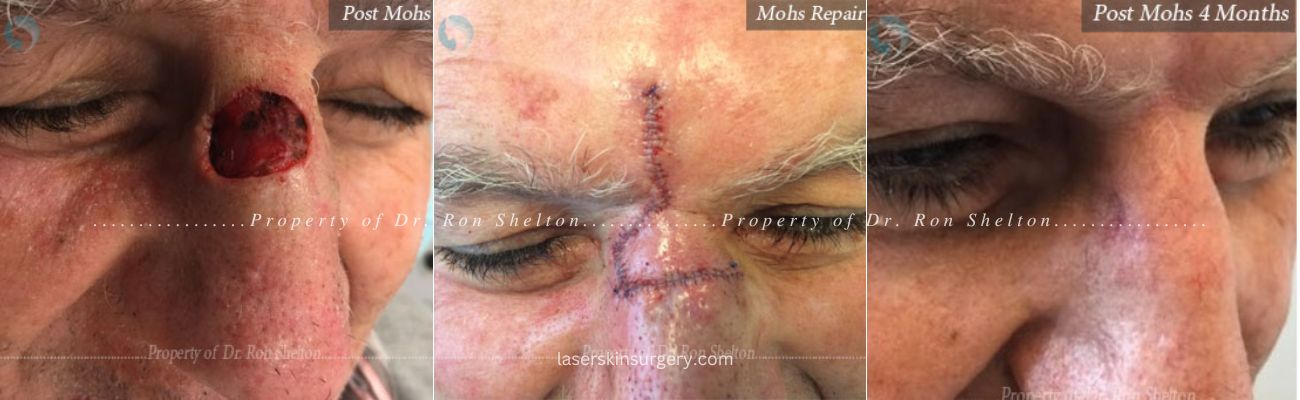 Mohs surgery, Mohs Repair and Post Mohs 4 Months on the nose