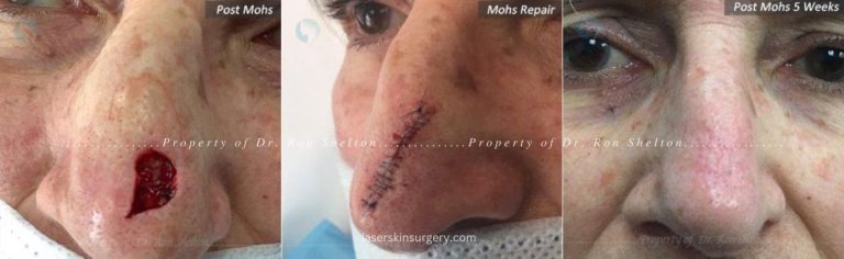 Post Mohs surgery, Mohs Repair and Post Mohs 5 Weeks