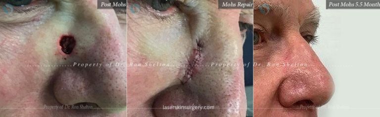 Post Mohs surgery, Mohs Repair and Post Mohs 5.5 Months