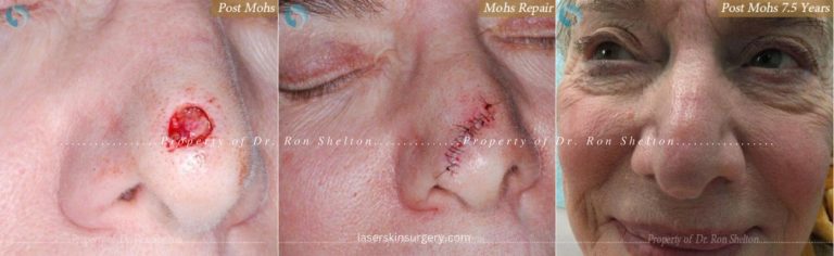 Post Mohs surgery, Mohs Repair and Post Mohs 7.5 Years