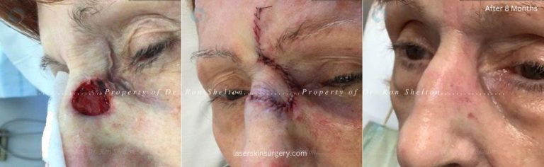 Post Mohs surgery, Mohs Repair and Post Mohs 8 Months