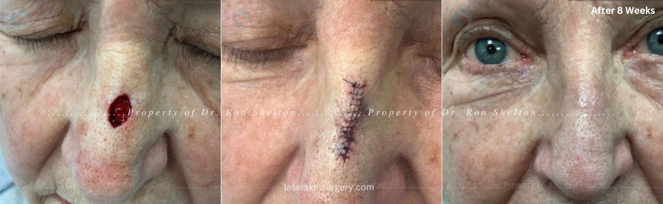 Mohs surgery on the nose, Mohs repair and after 8 weeks