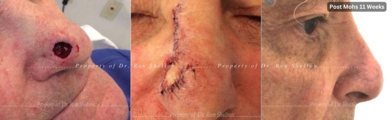 Mohs surgery on the nose, repair and 11 weeks