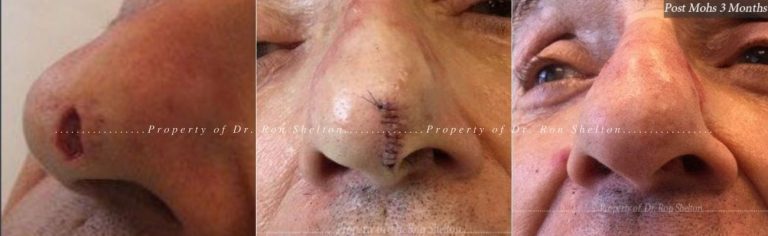 Mohs surgery on the nose, repair and 3 months after the surgery