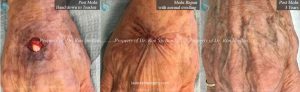 Mohs defect, hand down to tendon, Mohs Repair and After 3 Years