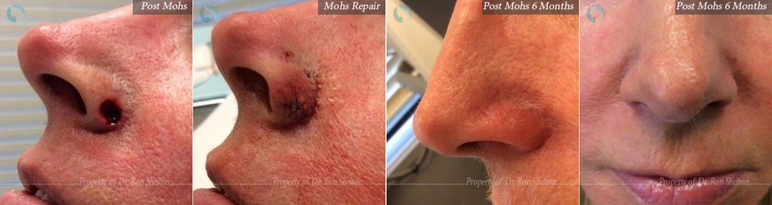 Mohs surgery on the nose, Mohs Repair and Post Mohs 6 Months