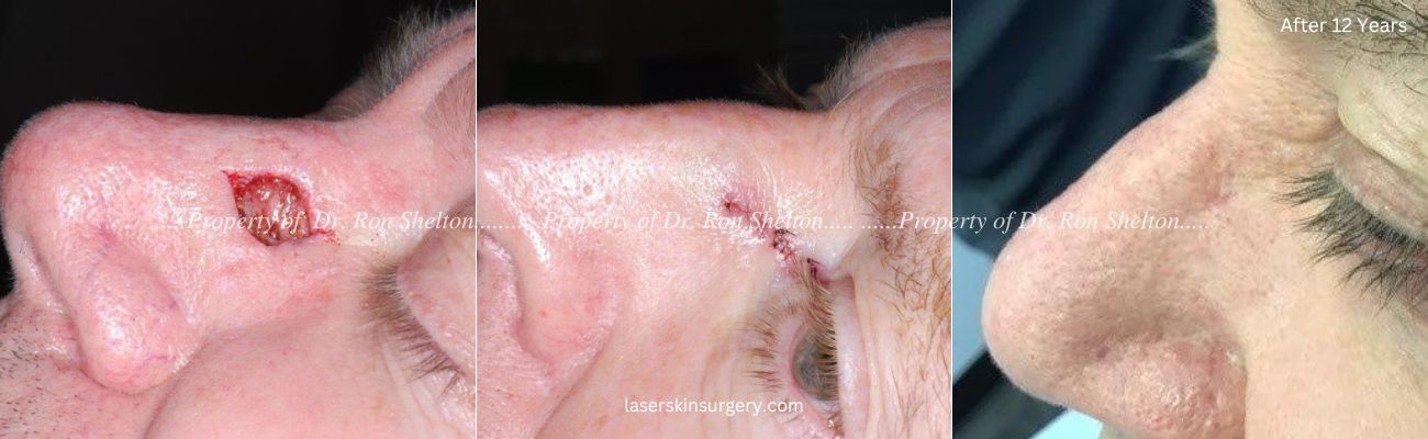 Post Mohs surgery on nasal bridge, Repair and Post Mohs 12 Years
