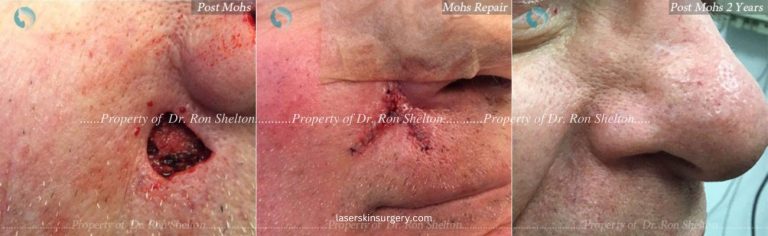Post Mohs Surgery on the Lip, Mohs Repair and After 2 Years