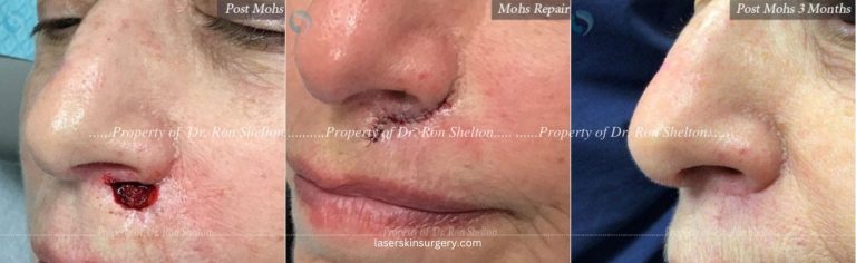 Post Mohs Surgery on the Lip, Mohs Repair and After 3 Months