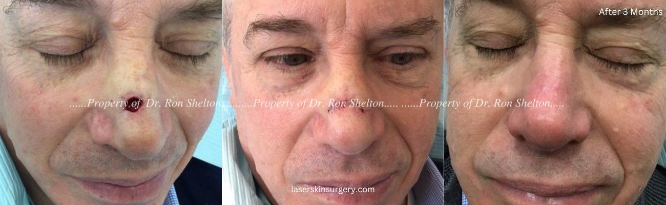 Mohs surgery on the nose - Post Mohs, Repair and 3 Months