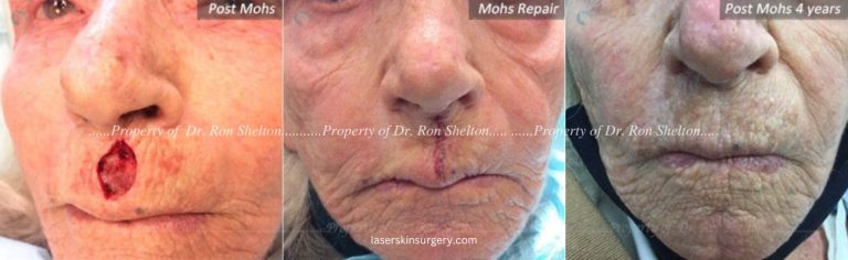 Post Mohs Surgery on the Lip, Mohs Repair and After 4 Years
