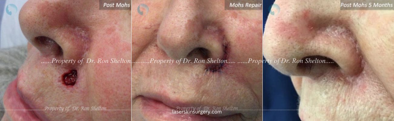 Post Mohs Surgery on the Lip, Mohs Repair and After 5 Months