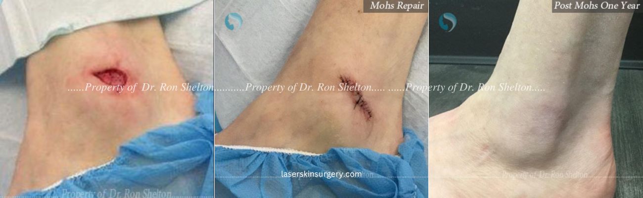 Post Mohs of Squamous Cell Carcinoma on left outer ankle, Mohs Repair and After 1 Year