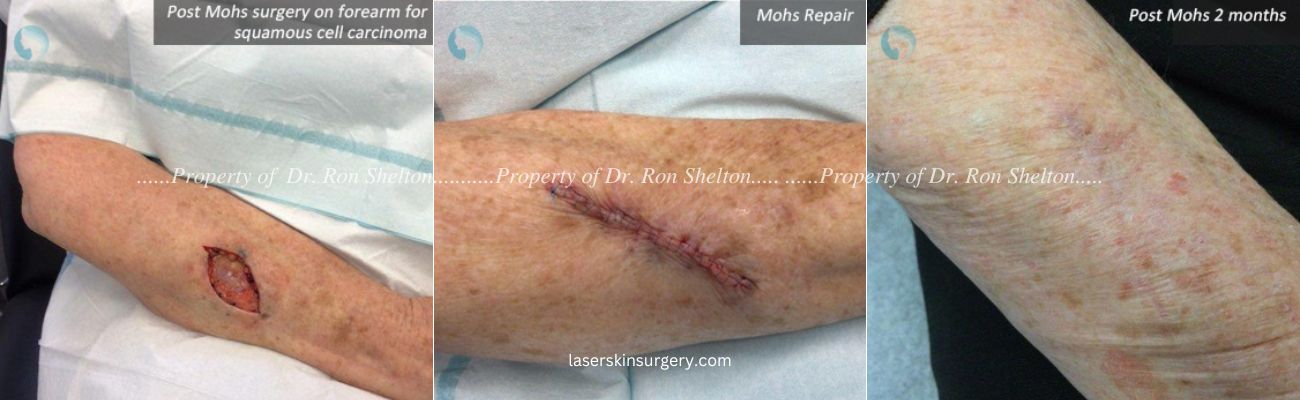 Post Mohs surgery on forearm for squamous cell carcinoma, Mohs Repair and After 2 Months