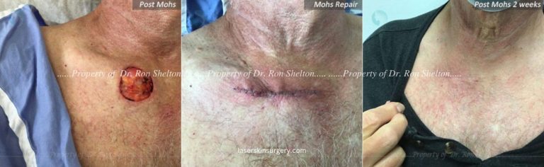 Mohs Surgery on the Neck, Mohs Repair and After 2 Weeks