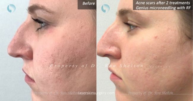Above patient shows significant improvement in acne scars after Genius microneedling with radiofrequency despite not having done a complete series as it normally involves 3 treatments.