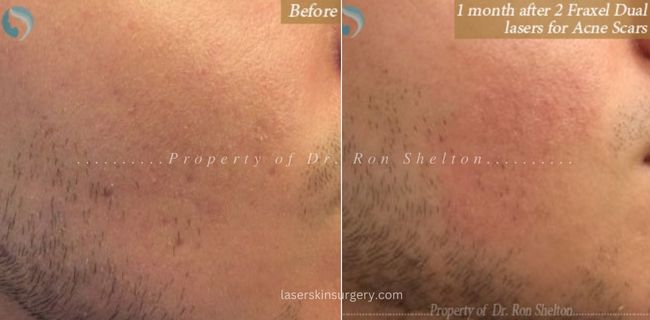 Before and After two Fraxel Restore – Dual laser treatments for Acne Scars