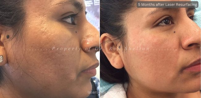 5 Months after Two treatments with Fraxel Restore/Dual laser and one Permea for Acne Scars