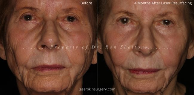 Before and 4 Months after Laser Resurfacing, Sciton Contour and Profractional