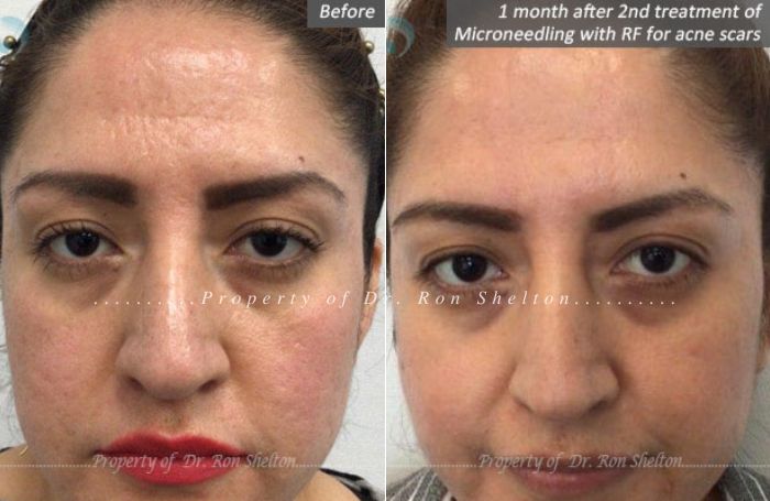 1 month after 2nd treatment of Microneedling with RF for acne scars