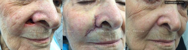 15 weeks post Mohs right upper cutaneous lip and flap closure
