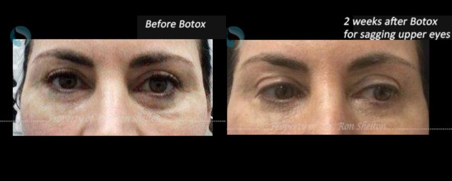 2 weeks after Non surgical Botox Brow lift. (helped lift her sagging upper eyes)