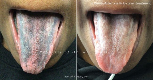 One treatment with ruby laser for pigmented papillae of the tongue, dark tongue