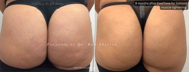 9 months post series of CoolTone Buttock Muscle Stimulation for muscle tightening. In this case we see good cellulite improvement which was not expected!