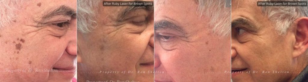 Before and After Ruby Laser for Brown Spots