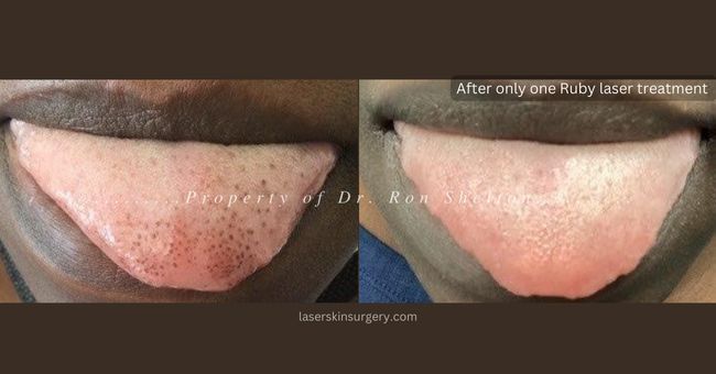 After only one Ruby laser treatment for pigmented Papillae of the tongue nyc