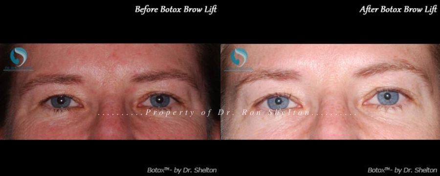 Botox for Brow Lift