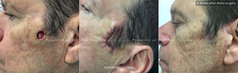 Mohs surgery on the cheek, repair and after 9 weeks