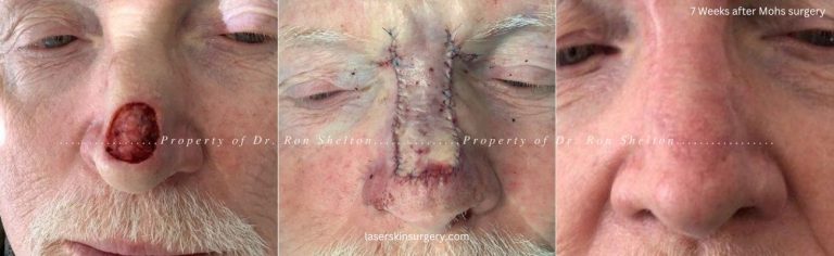New York City Mohs surgery on the nose, extensive flap and after 7 weeks