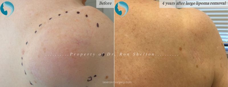 4 Years after large lipoma removal