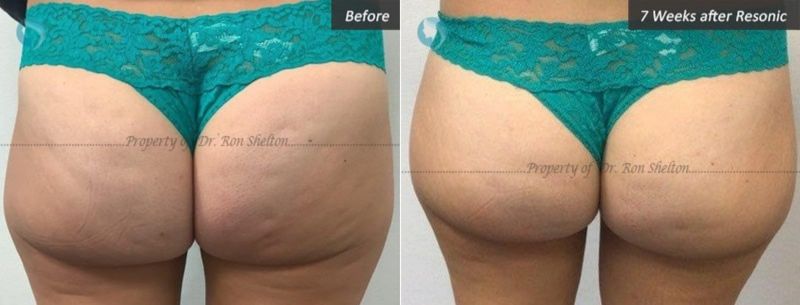 Patient in her 40's before and 7 weeks after Resonic for cellulite