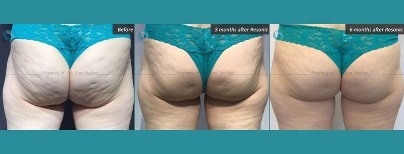 Patient in her 60's before and 3 months and 6 months after Resonic for cellulite
