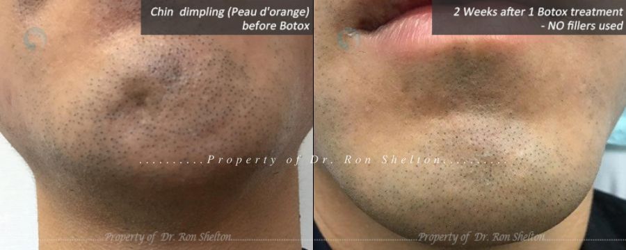 Botox for Dimpling of chin (Peau d'orange) and 2 weeks after botox without any fillers