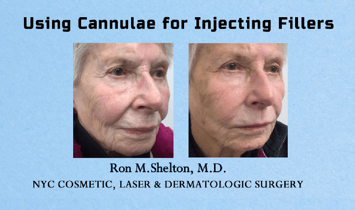 fillers with cannula