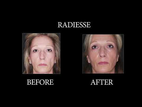 NYC Radiesse before and after