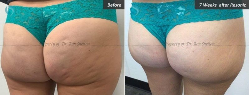 Patient in her 40's before and 7 weeks after Resonic for cellulite Dr Shelton expects the results to do even better in next six months