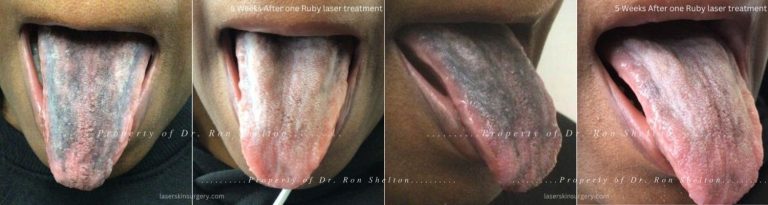 One treatment with ruby laser for pigmented papillae of the tongue, dark tongue