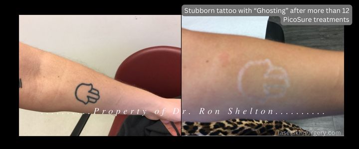 Stubborn tattoo with “Ghosting” after more than 12 PicoSure treatments