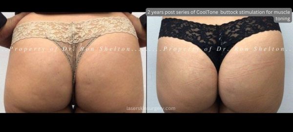 Cooltone for muscle tightening