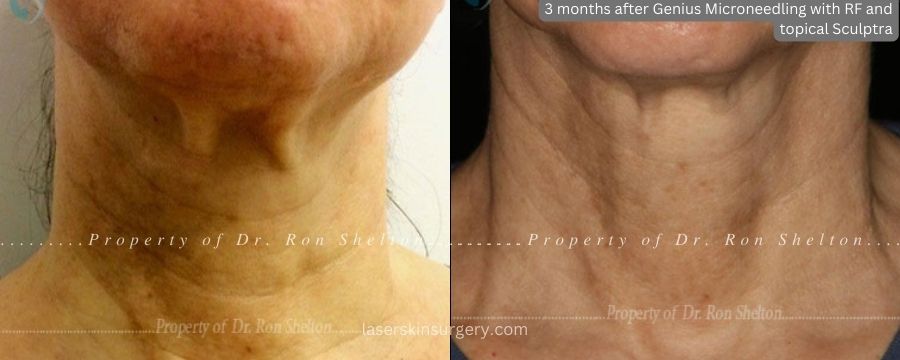 3 months after Genius Microneedling with Radiofrequency & topical Sculptra for techneck