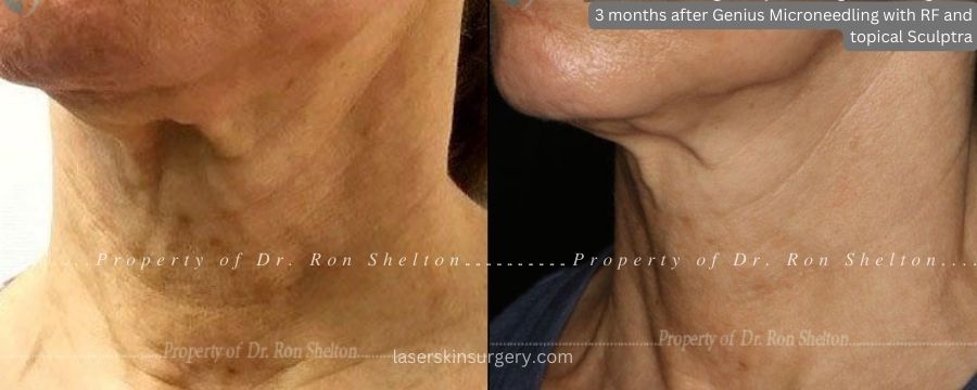 3 months after Genius Microneedling with Radiofrequency & topical Sculptra for techneck