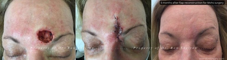 5 months after flap reconstruction for Mohs surgery and 2 Vbeam lasers for redness, one injection of corticosteroid for swelling. No laser resurfacing was done. The special flap was designed as Dr. Shelton did not want to distort the position of the inner eyebrow, and in the end, was able to achieve perfect symmetry.
