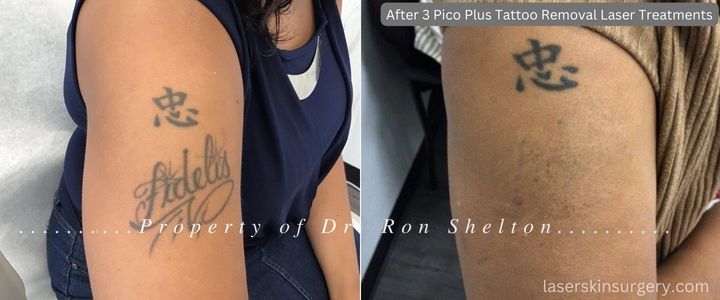 After 3 Pico Plus Tattoo Removal Laser Treatments
