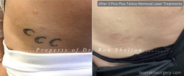 Post 3 PicoPlus, 1064nm. laser treatments for tattoo removal. Slight hyperpigmentation from her skin response which is fading.