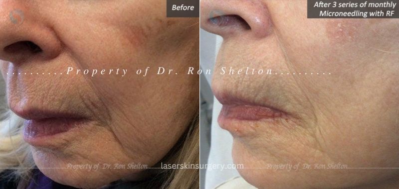 Above patient in late 70s who had a series of 3 monthly Microneedling with RF to the lines around the mouth and cheeks. Minimal downtime unlike ablative laser resurfacing. Can be done again in six months.